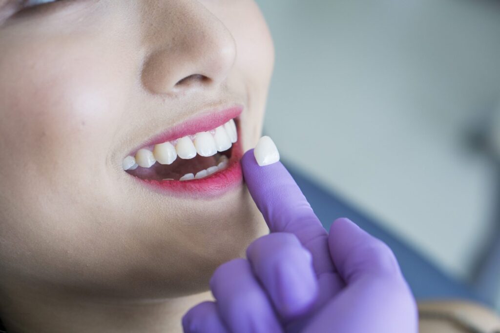 veneers